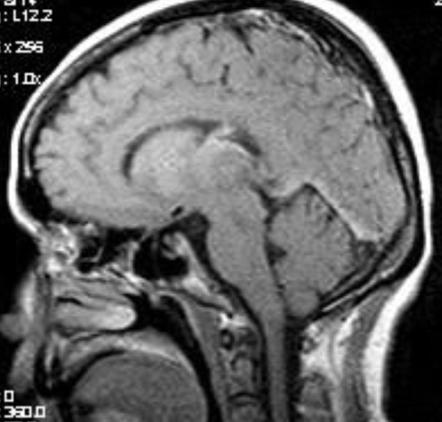 Deep cerebral vein thrombosis | Radiology Reference Article ...