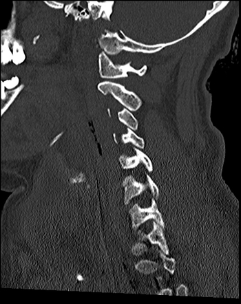 Atlanto-occipital dissociation injuries | Radiology Reference Article ...