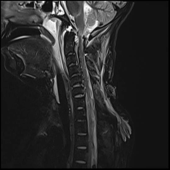 Atlanto-occipital dissociation - Traynelis type 1 | Image | Radiopaedia.org