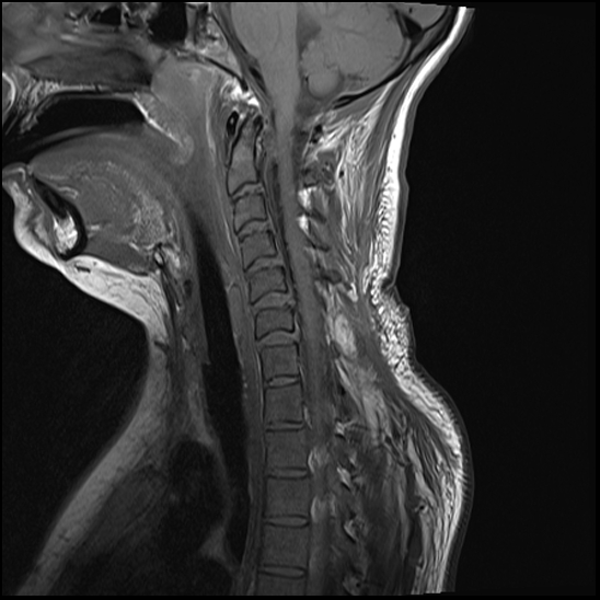 Atlanto-occipital dissociation - Traynelis type 1 | Image | Radiopaedia.org