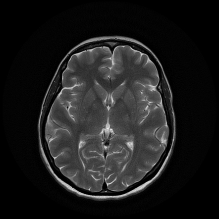 Normal noncontrast MR venography | Image | Radiopaedia.org