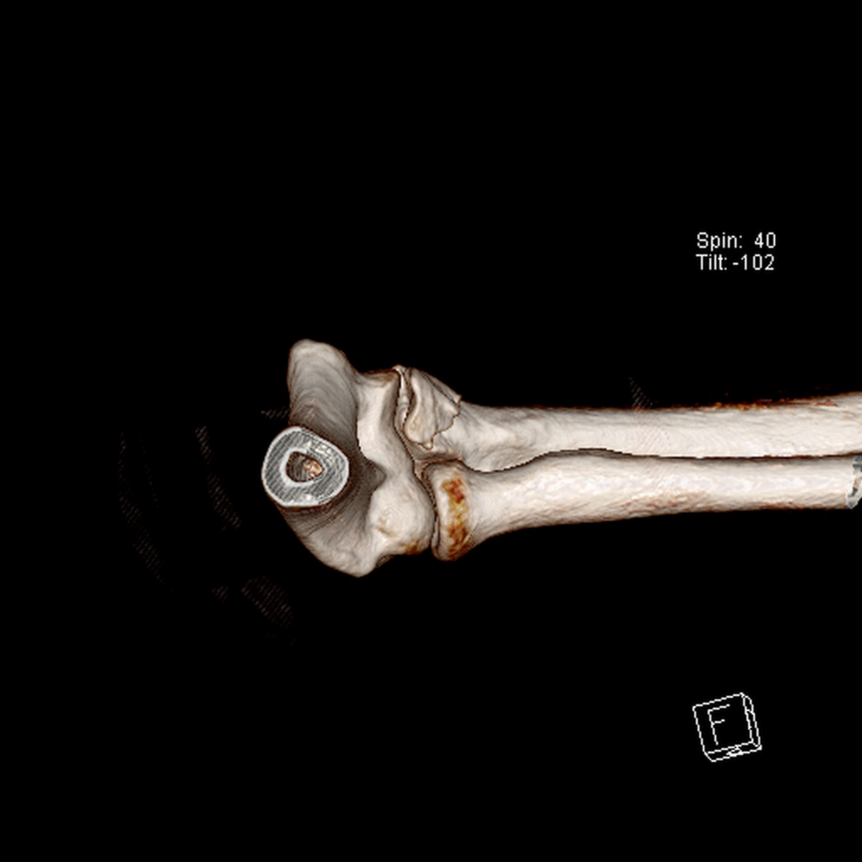 Coronoid process fracture | Image | Radiopaedia.org