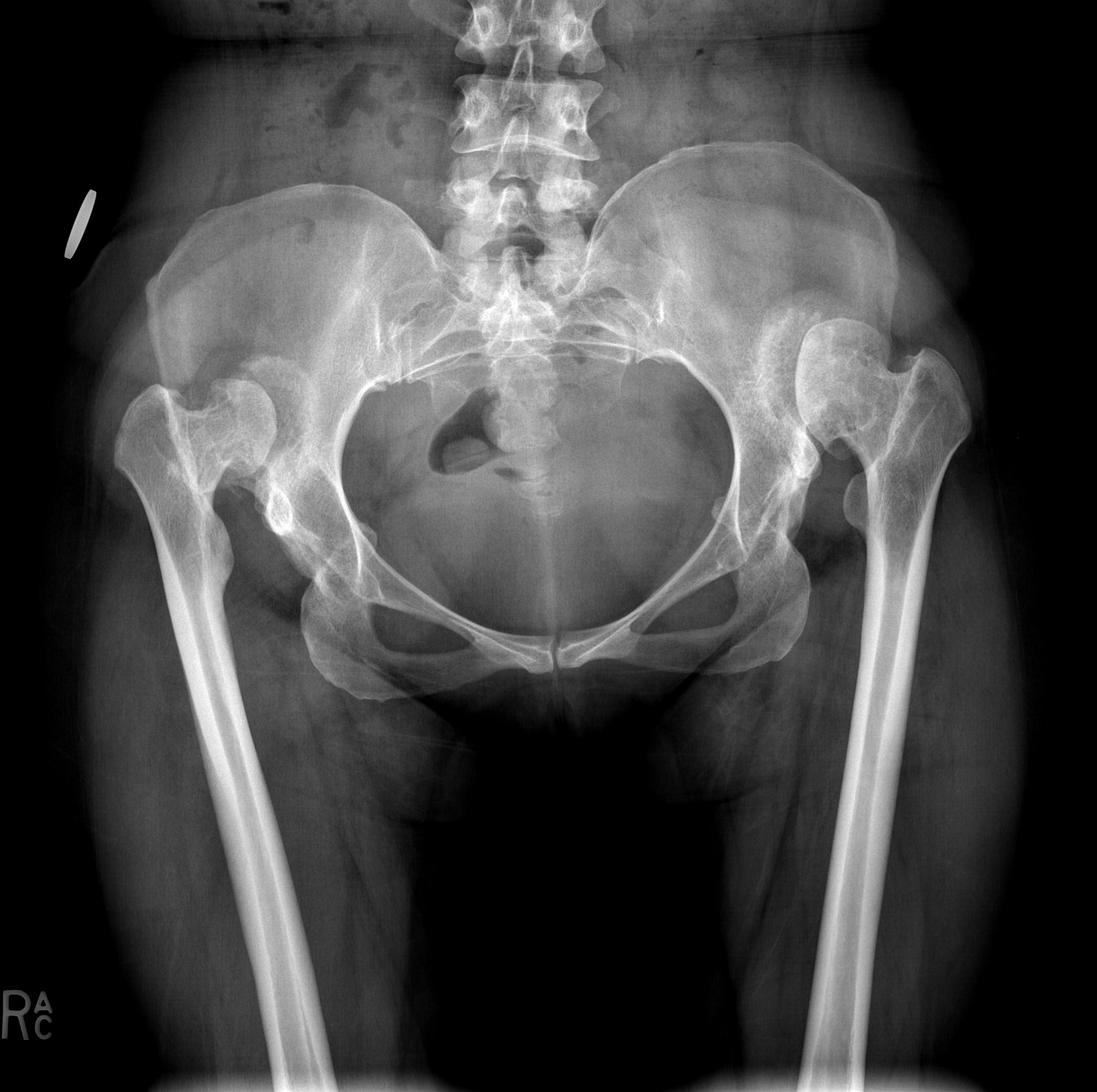 Untreated Chronic Bilateral Hip Dysplasia Image Radiopaedia Org