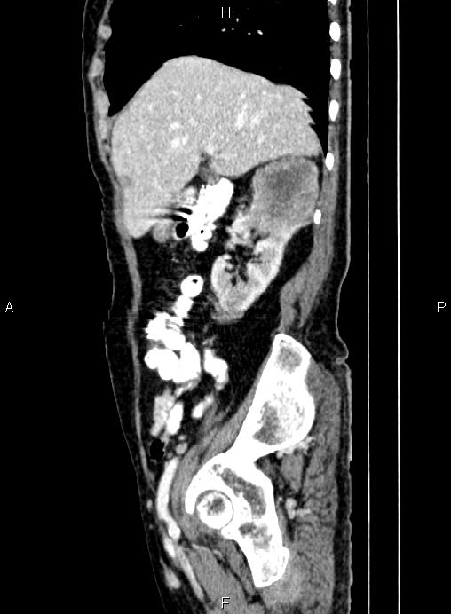 Renal Cell Carcinoma Image Radiopaedia Org