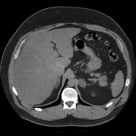 Adrenal adenoma | Radiology Case | Radiopaedia.org