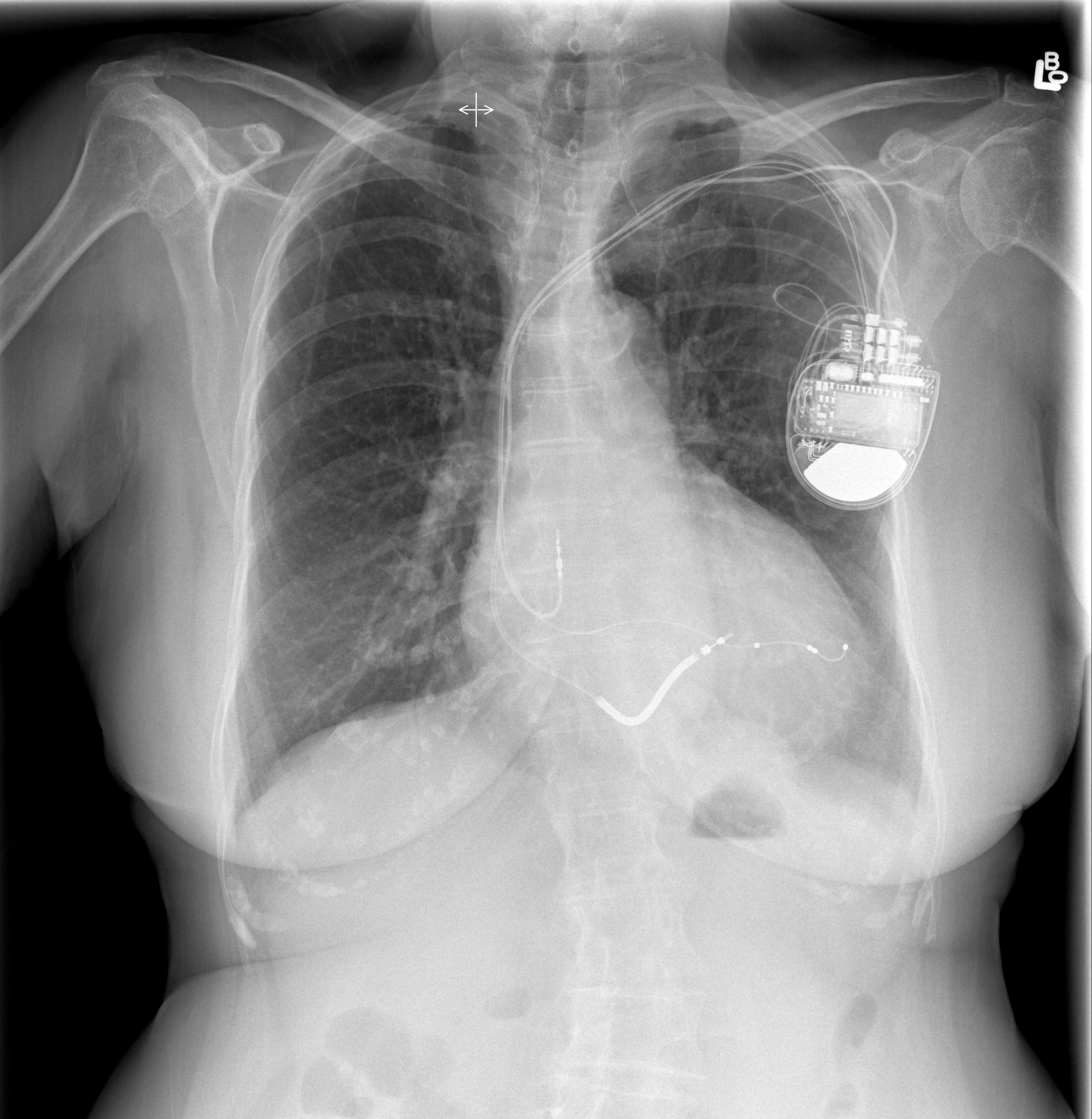 Cardiac resynchronisation therapy | Image | Radiopaedia.org