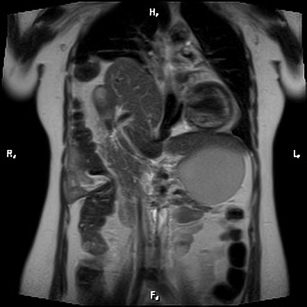 Diaphragmatic Hernia X Ray