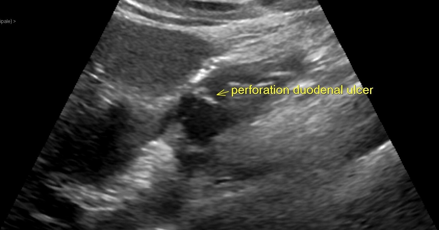 Pneumoperitoneum due to duodenal ulcer perforation (US) | Image ...