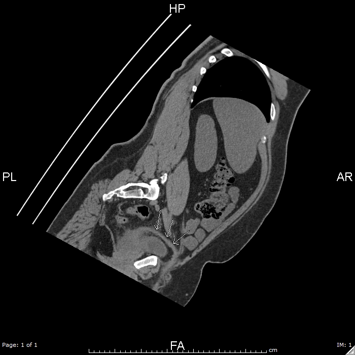 Seminal vesiculitis, vasitis and prostatitis | Image | Radiopaedia.org