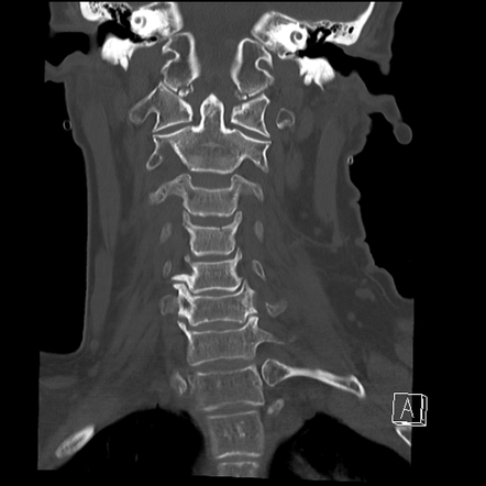 Occipital condyle fracture | Radiology Reference Article | Radiopaedia.org