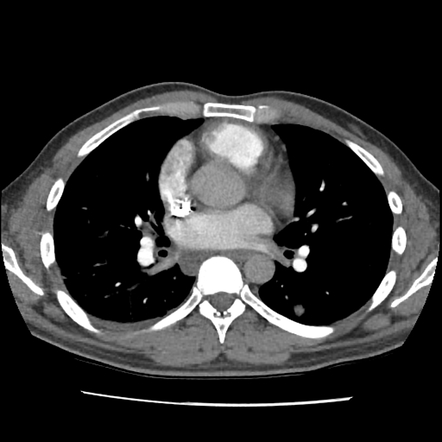 Pulmonary septic emboli | Image | Radiopaedia.org