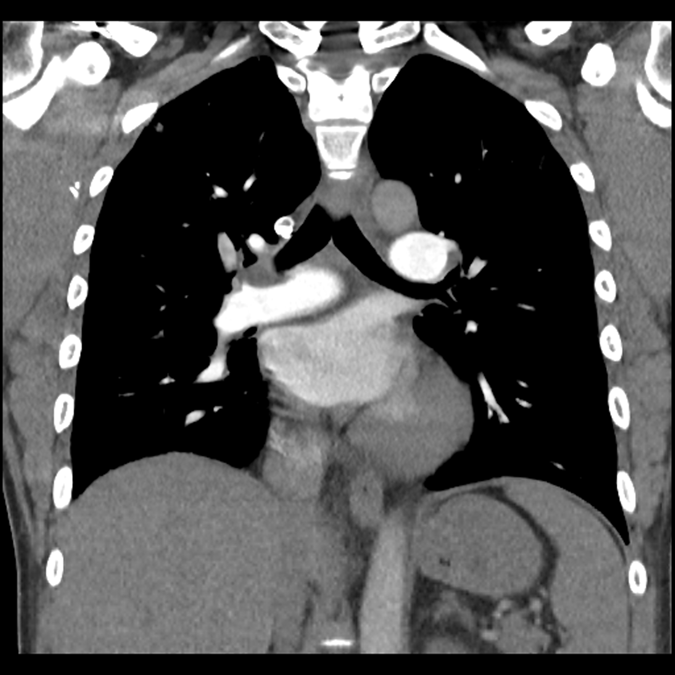 Pulmonary septic emboli | Image | Radiopaedia.org