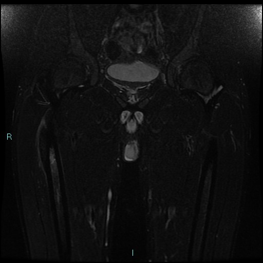 Osteoid osteoma of the femur | Image | Radiopaedia.org