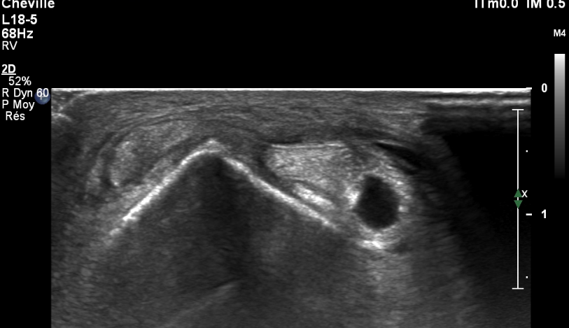 Peroneus brevis tendon dislocation | Image | Radiopaedia.org