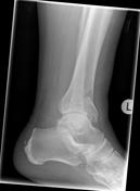 Viewing playlist: imprtant lower limb xray for emergency medicine board ...