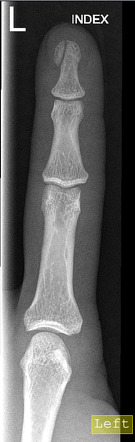 distal fracture phalanx tuft radiopaedia radiology