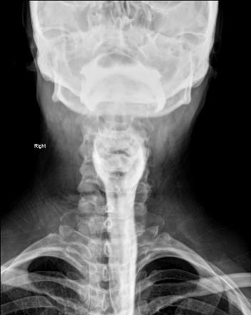 Ring-like esophageal peptic stricture | Image | Radiopaedia.org