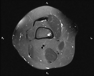 Ossifying Fibroma 