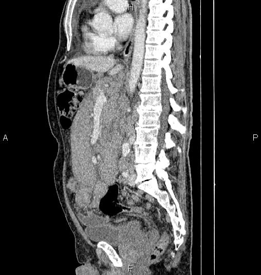 Sandwich sign | Image | Radiopaedia.org