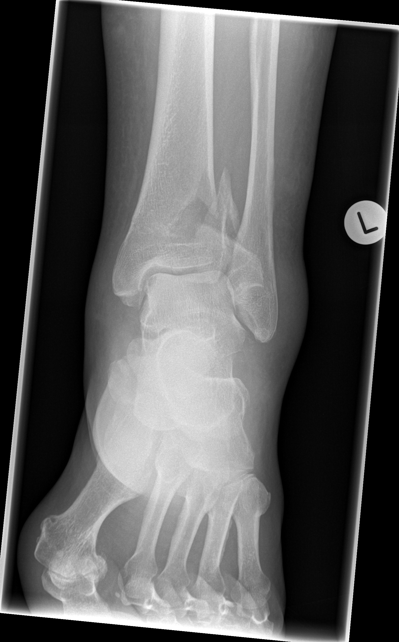 Pilon Fracture | Image | Radiopaedia.org