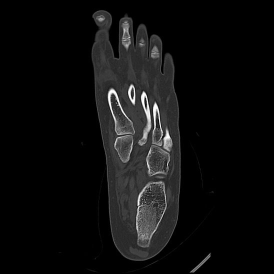 Normal Foot Ct With 3d Vrts Image