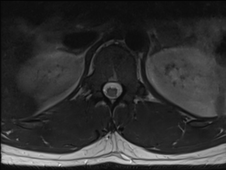 Transverse myelitis | Image | Radiopaedia.org