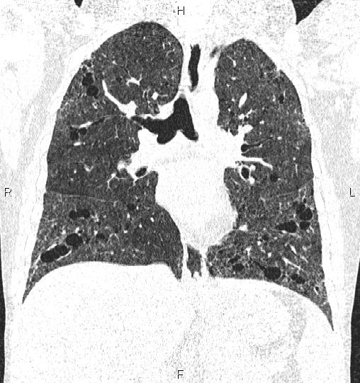 Scleroderma Related Interstitial Lung Disease Image 7099