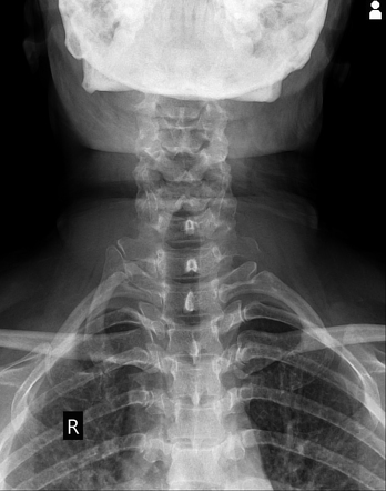 Cervical rib with pseudoarthrosis and facet arthropathy | Image ...