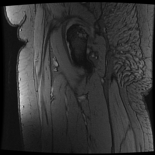 Bilateral Femoral Head Avascular Necrosis Image 4802