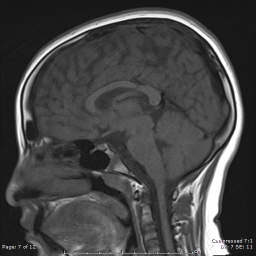 Moyamoya disease | Image | Radiopaedia.org