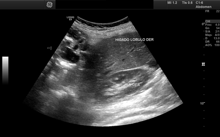 Gliomatosis Peritonei In Mature Ovarian Teratoma Radiology Case Radiopaedia Org