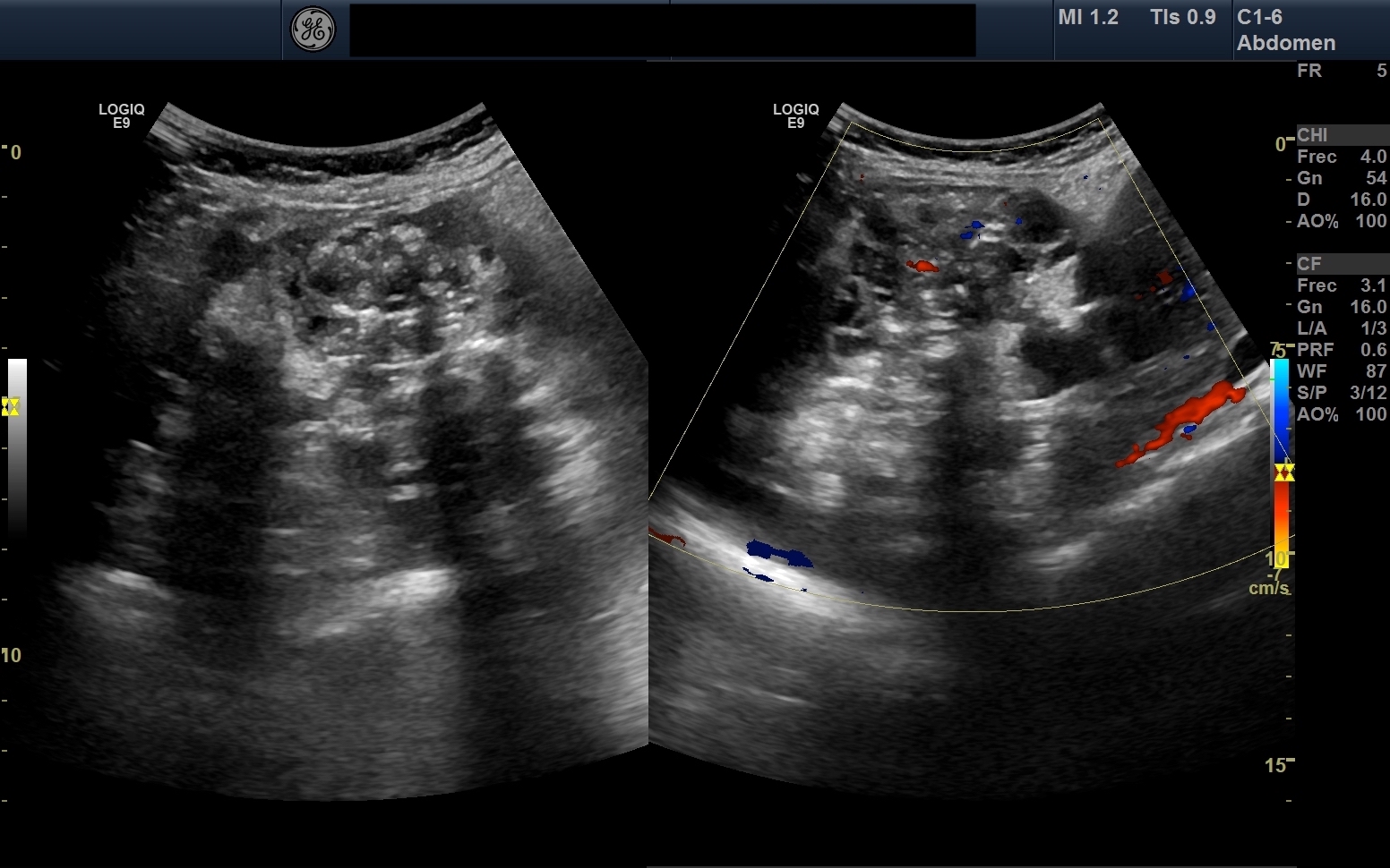 Gliomatosis Peritonei In Mature Ovarian Teratoma Image Radiopaedia Org