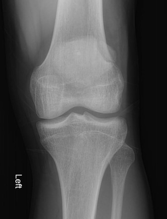 Bipartite patella | Radiology Case | Radiopaedia.org