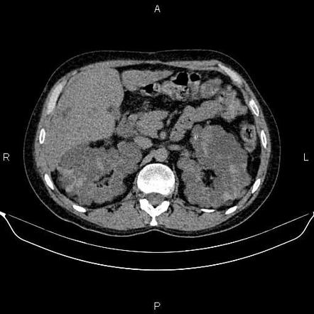 Autosomal dominant polycystic kidney disease | Image | Radiopaedia.org