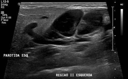 Jugulodigastric lymph node - normal (ultrasound) | Radiology Case ...