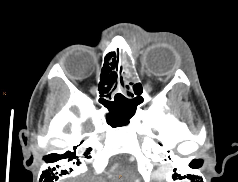 Orbital Cellulitis Complicated By Superior Ophthalmic Vein And Cavernous Sinus Thrombosis