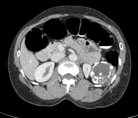 Splenic epidermoid cyst | Radiology Case | Radiopaedia.org