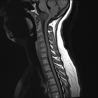 Chordoma - clivus | Image | Radiopaedia.org