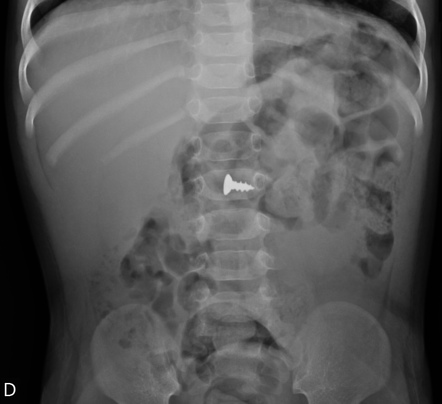 Foreign body ingestion | Radiology Case | Radiopaedia.org