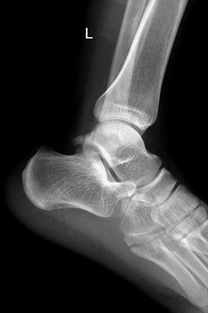 Fracture Of The Base Of The 5th Metatarsal Bone 