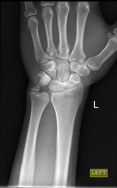 styloid process ulna