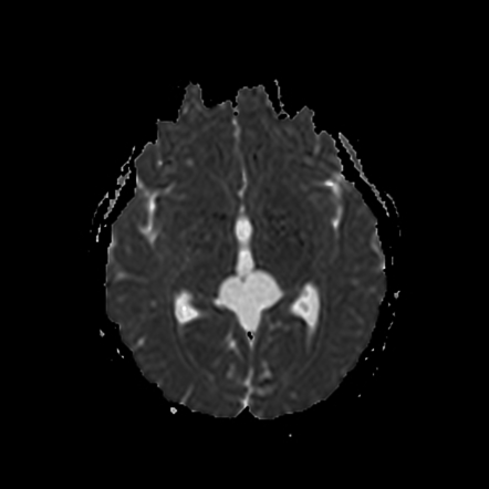 Quadrigeminal cistern arachnoid cyst | Image | Radiopaedia.org