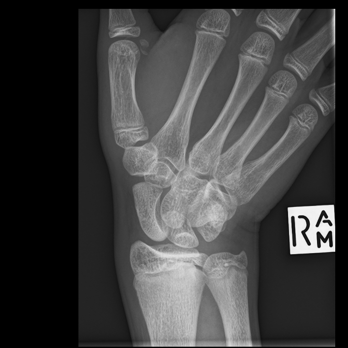 Fracture of the ulnar sesamoid of the first metacarpophalangeal joint ...