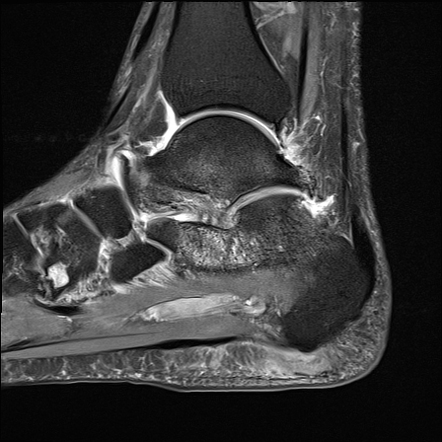 Extra-articular lateral hindfoot impingement | Image | Radiopaedia.org