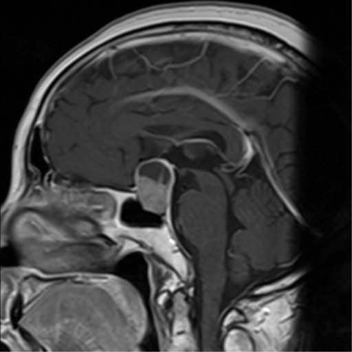 Pituitary Macroadenoma With Cystic Degeneration Image