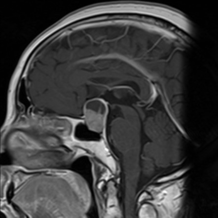 Pituitary macroadenoma with cystic degeneration | Image | Radiopaedia.org