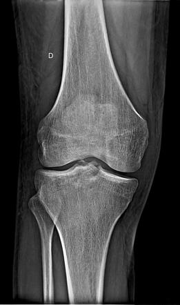 Anterior cruciate ligament avulsion fracture | Radiology Case ...