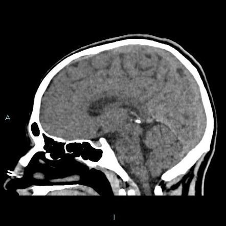 Optic disc drusen | Image | Radiopaedia.org