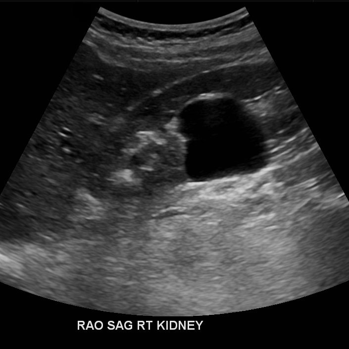 ultrasound-of-the-paediatric-kidney-the-bmj