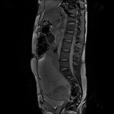 Normal MRI abdomen in pregnancy | Image | Radiopaedia.org